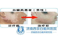 孕妇患者如何做好白癜风的护理工作 孕妇患者如何做好白癜风的护理工作