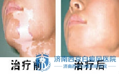 为什么青少年白癜风发病率这么高 为什么青少年白癜风发病率这么高