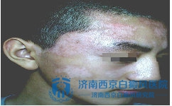 兰州哪家医院治白癜风 兰州哪家医院治白癜风